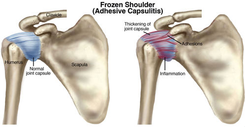 Top 10 Shoulder Pain Causes
