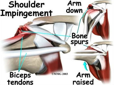 Top 10 Shoulder Pain Causes