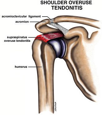Top 10 Shoulder Pain Causes