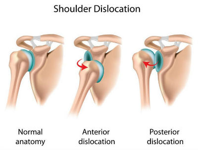 Top 10 Shoulder Pain Causes
