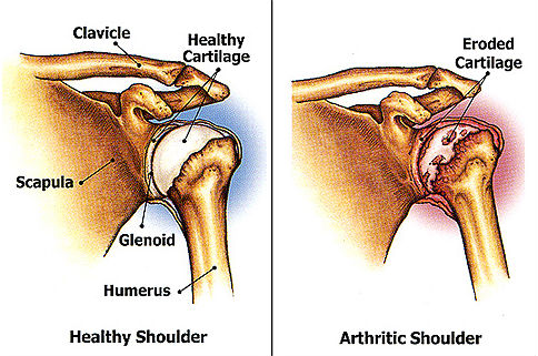 Top 10 Shoulder Pain Causes