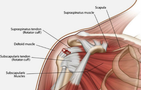 Top 10 Shoulder Pain Causes