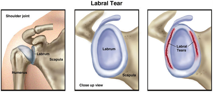 Top 10 Shoulder Pain Causes