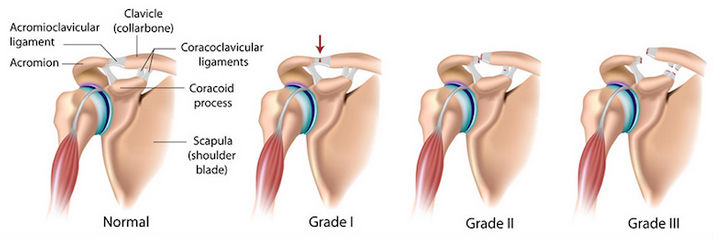 Top 10 Shoulder Pain Causes