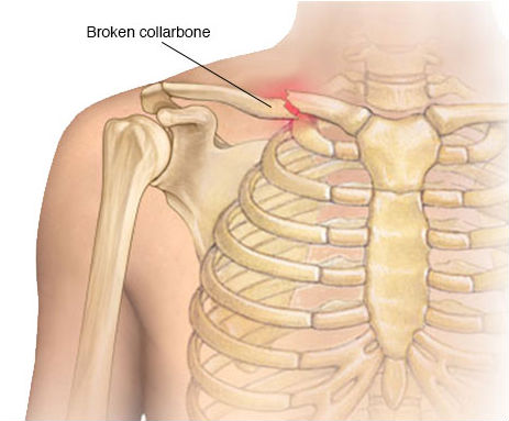Top 10 Shoulder Pain Causes