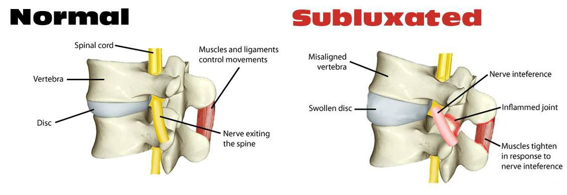 What Is Chiropractic Adjustment