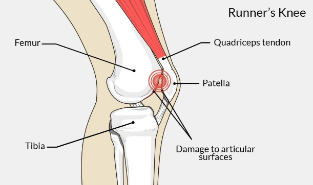 Top 10 Most Common Sports Injuries