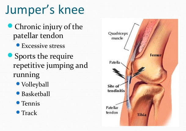 Top 10 Most Common Sports Injuries