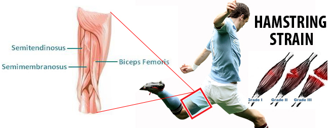 Top 10 Most Common Sports Injuries