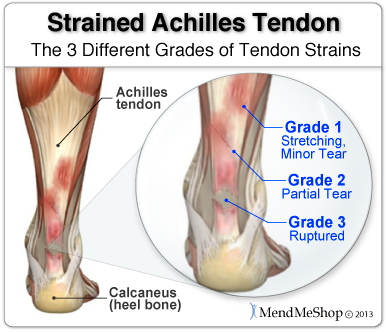 Top 10 Most Common Sports Injuries