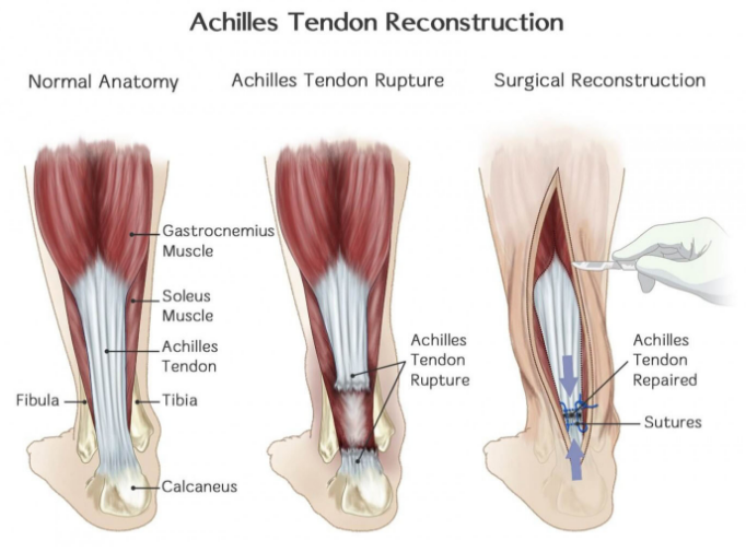 Top 10 Most Common Sports Injuries
