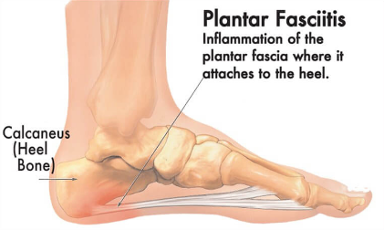 Top 10 Most Common Sports Injuries