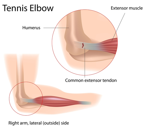 Top 10 Most Common Sports Injuries