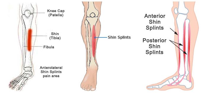 Top 10 Most Common Sports Injuries