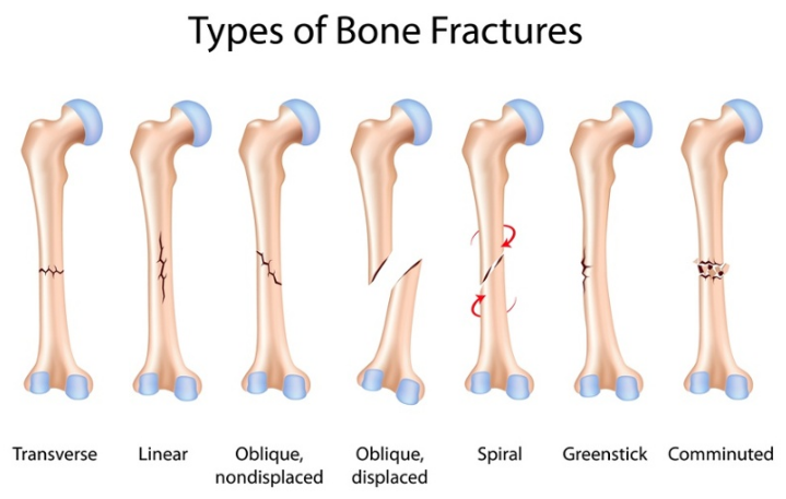 Top 10 Most Common Sports Injuries